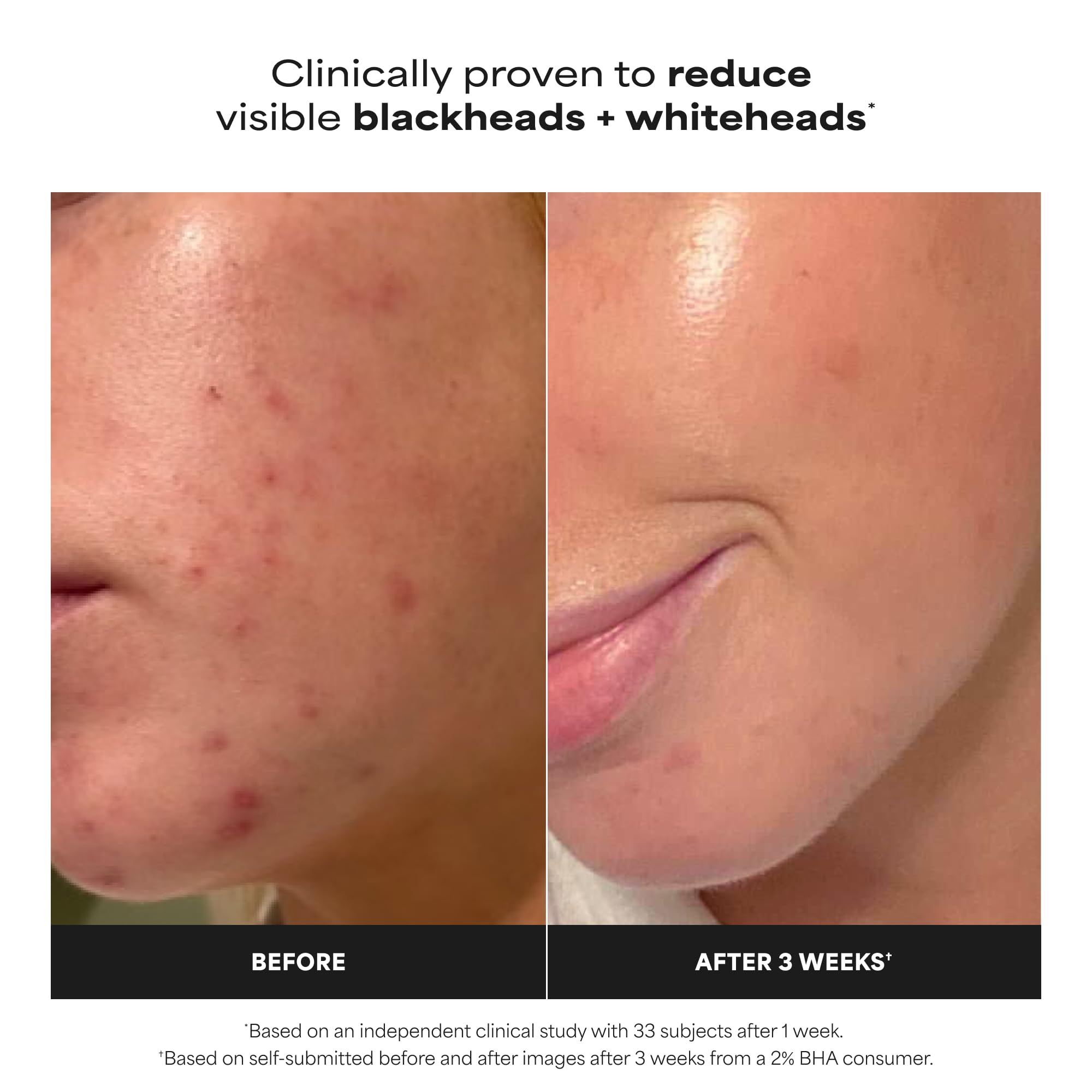 Paula's Choice SKIN PERFECTING 2% BHA Liquid Exfoliant thumbnail