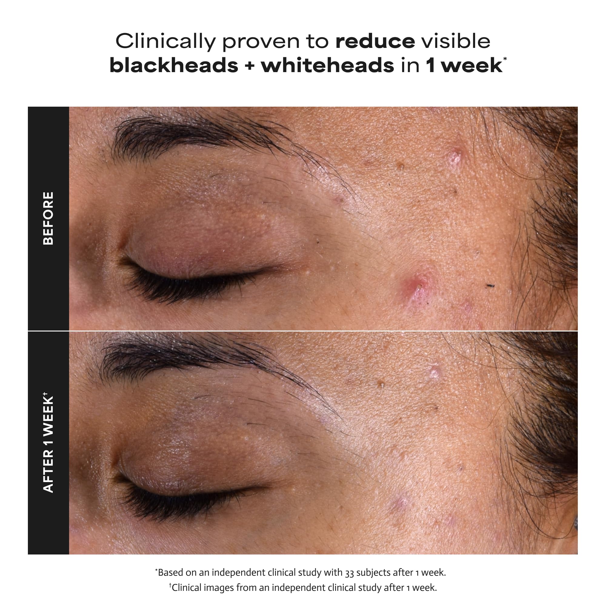 Paula's Choice SKIN PERFECTING 2% BHA Liquid Exfoliant thumbnail